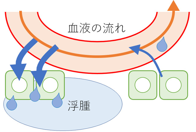 リンパ浮腫とは2