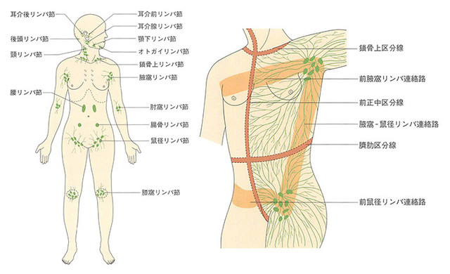 リンパ浮腫とは4